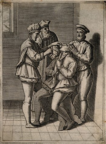 Credit: Wellcome Library, London. Wellcome Images
images@wellcome.ac.uk
http://wellcomeimages.org
A surgeon about to bleed a man's tongue, he is aided by two assistants. Engraving, 1586.
1586 Published: 1586]

Copyrighted work available under Creative Commons Attribution only licence CC BY 4.0 http://creativecommons.org/licenses/by/4.0/